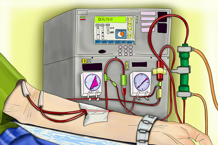 Using a dialysis machine outside the body filters the blood at the kidneys would